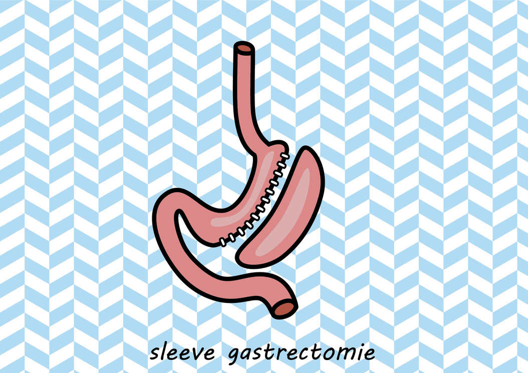 Sleeve gastrectomie